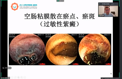他结合自身在小儿内科临床工作丰富的经验,对胶囊内镜在儿童小肠疾病
